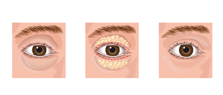 Eyelid Surfery Pre & Post