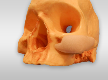Cheek Augmentation on Skull