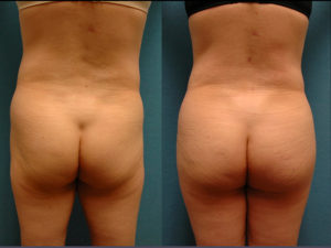 Before & 4 Months After