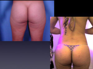 Before & 8 Weeks After