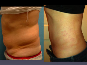 Before & 3 Months After