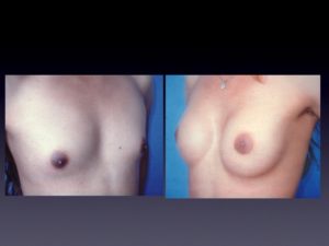 Before & 1 Year After
