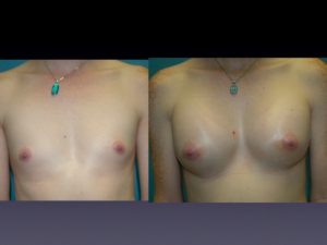 Before & 2 Weeks After