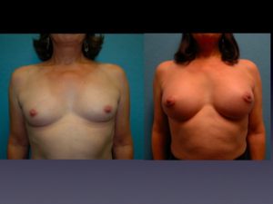 Before & 4 Months After