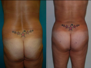 Before & 4 Months After