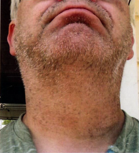 Patient 4 - Before