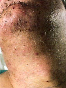 Patient 4 - After