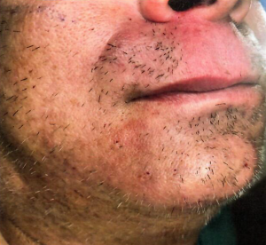 Patient 4 - After