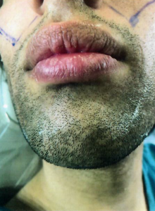 Patient 3 - Before