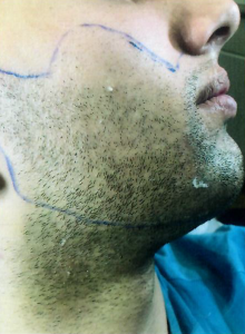 Patient 3 - Before