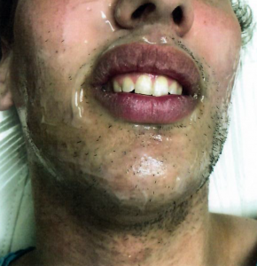 Patient 3 - After