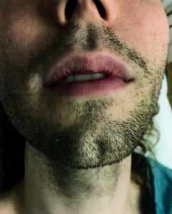 Patient 2 - Before