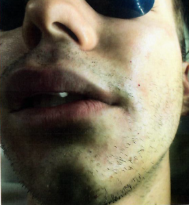 Patient 2 - After