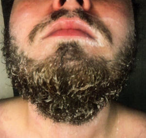 Patient 1 - Before