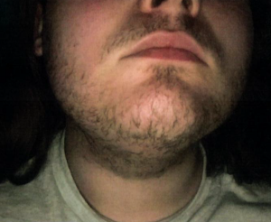 Patient 1 - After
