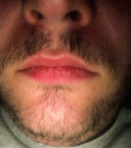 Patient 1 - After