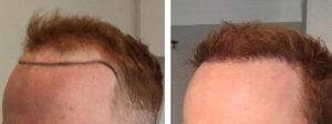 1 Year after Strip Graft