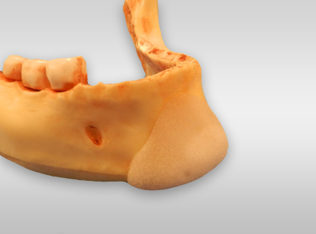 Chin Augmentation Surgery Implant